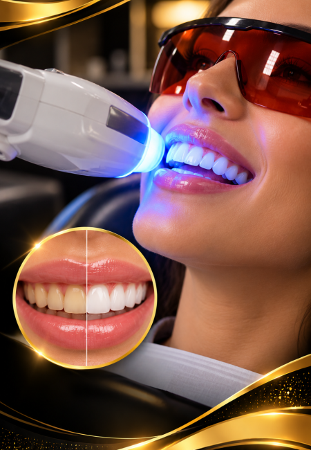 Blanqueamiento dental de lujo